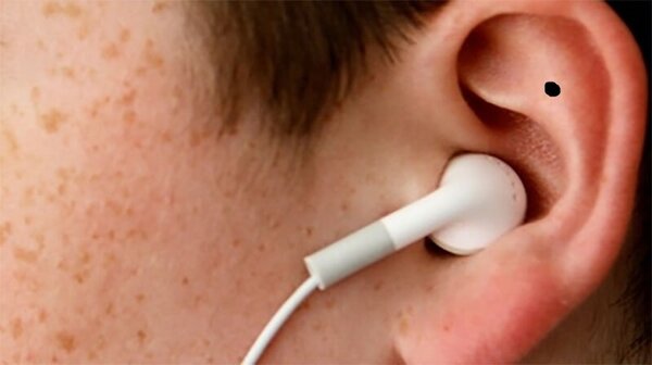 Nốt Ruồi Bên Trong Tai