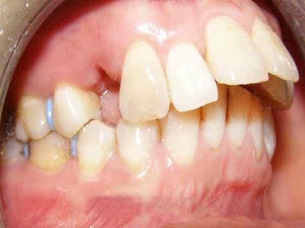 xem tướng răng hô