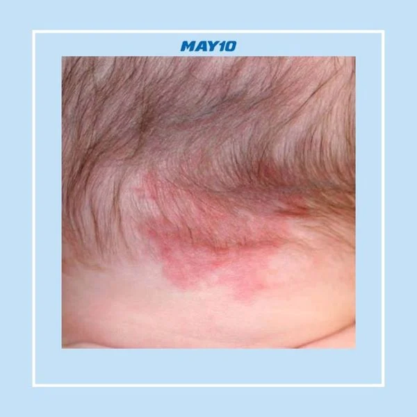 Đặc điểm và ý nghĩa của từng loại vết bớt trên đầu Đặc điểm và ý nghĩa của từng loại vết bớt trên đầu