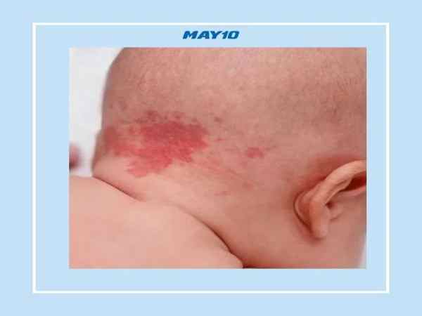 vết bớt trên đầu ý nghĩa gì