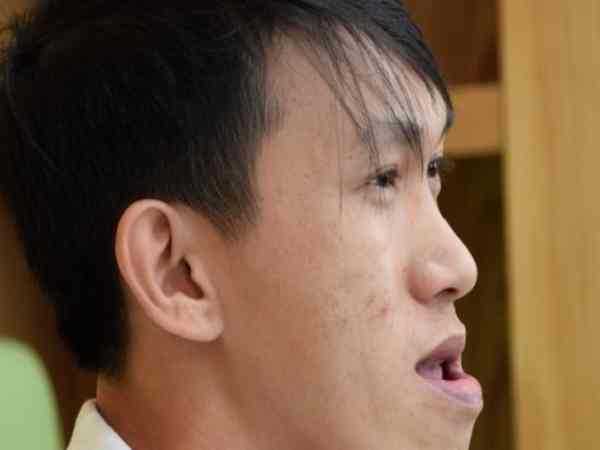 Tướng mặt lưỡi cày ở nam giới