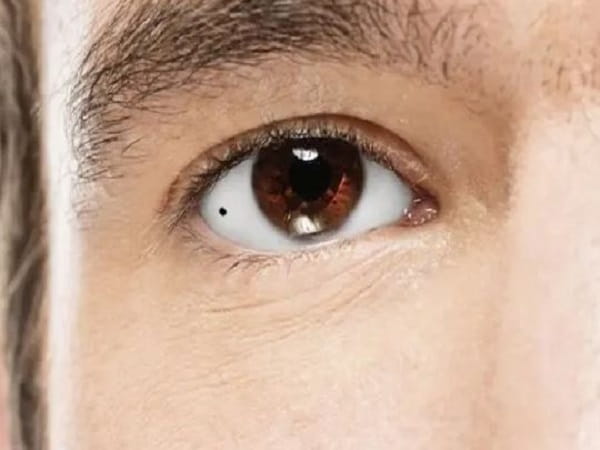 Mụn ruồi trong mắt phải tốt hay xấu?